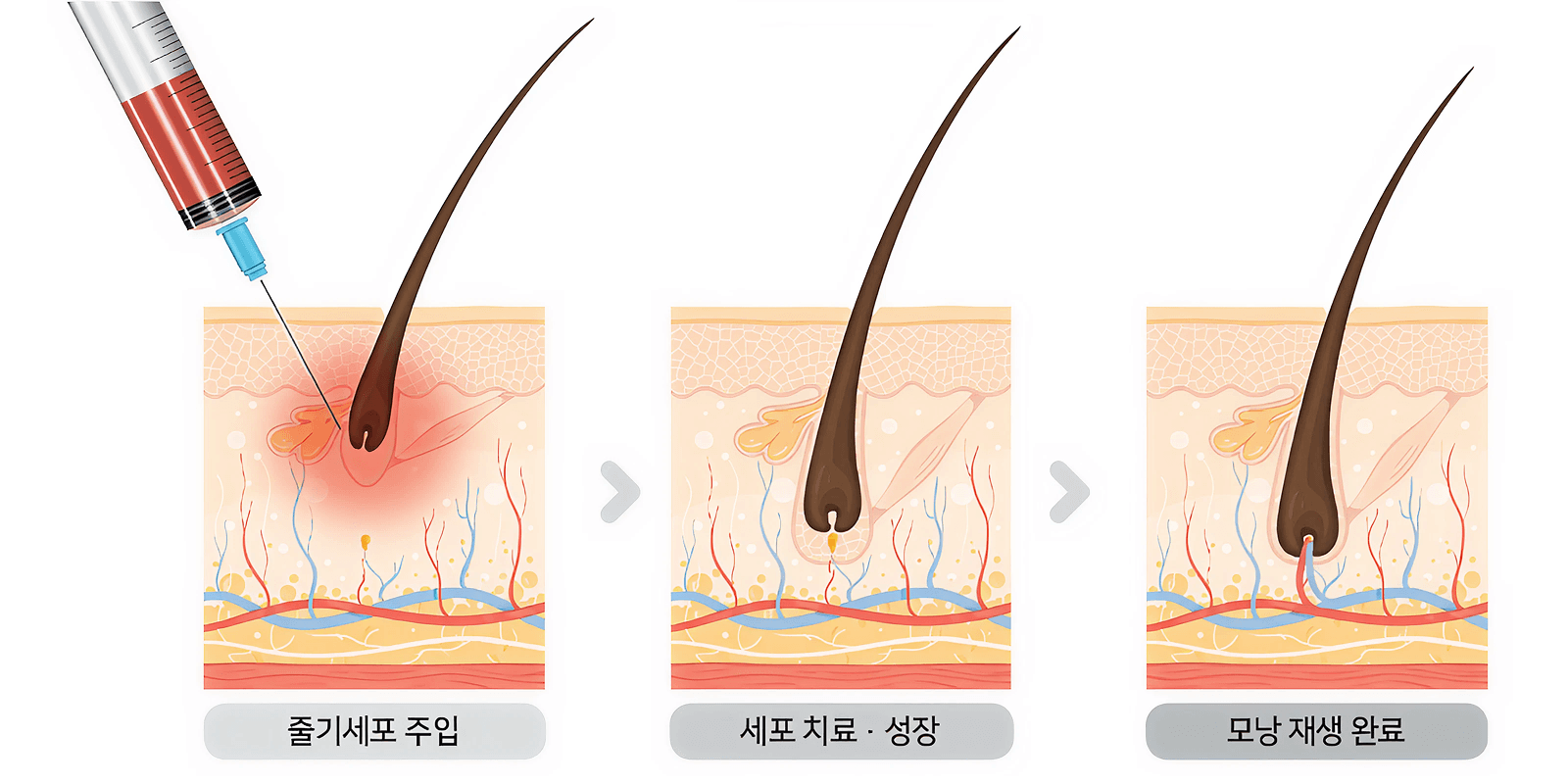 줄기세포 모발·탈모 치료 안내 이미지