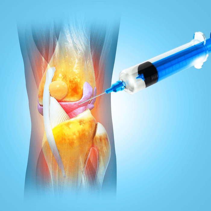 무릎 관절 줄기세포 주사 시술 이미지